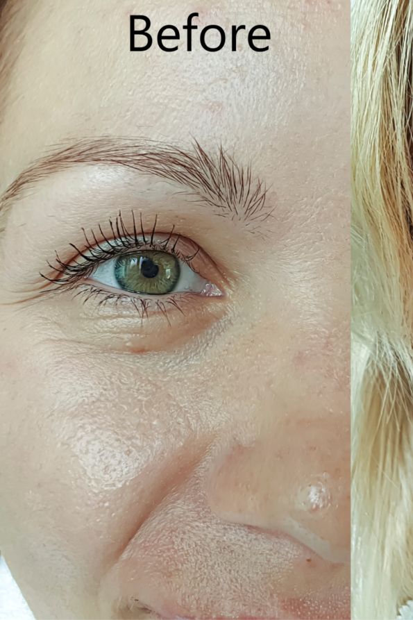 before Benefits of Retinol