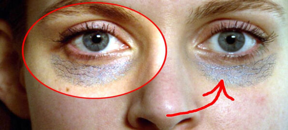 Mystery of Under-Eye Circles
