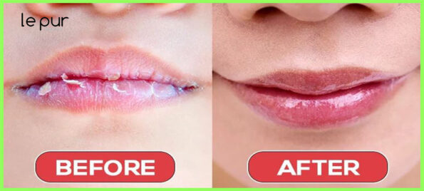 Repairing Cracked and Chapped Lips