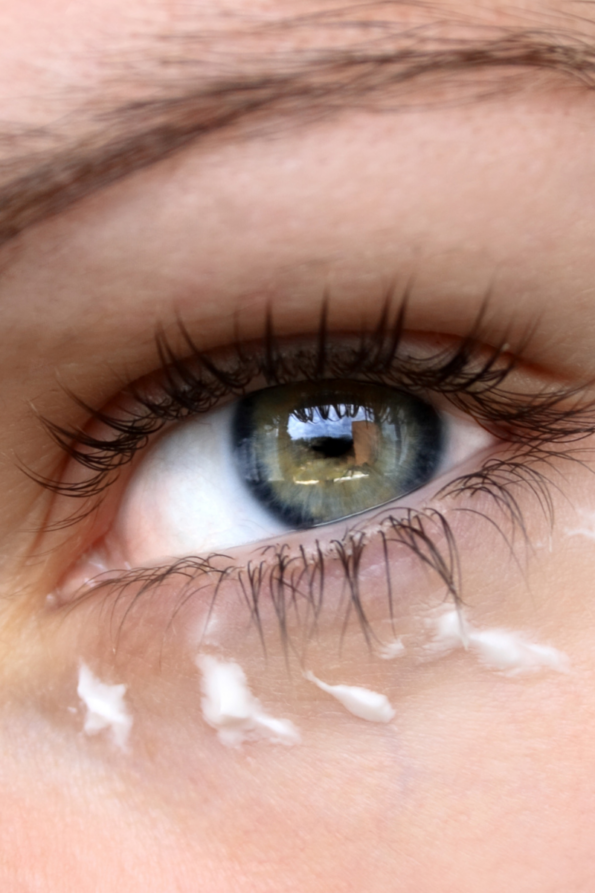 Understanding the Causes of Dark Circles
