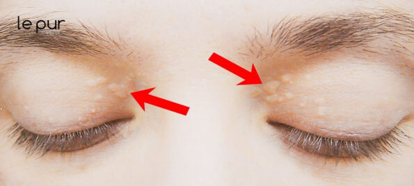 Delicate Skin Around the Eyes