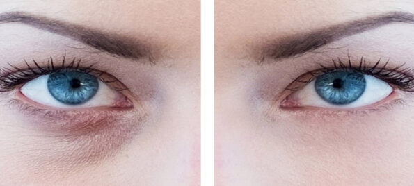 Reduction of Puffiness